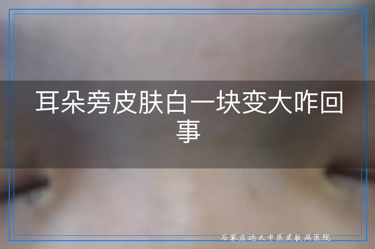 耳朵旁皮肤白一块变大咋回事