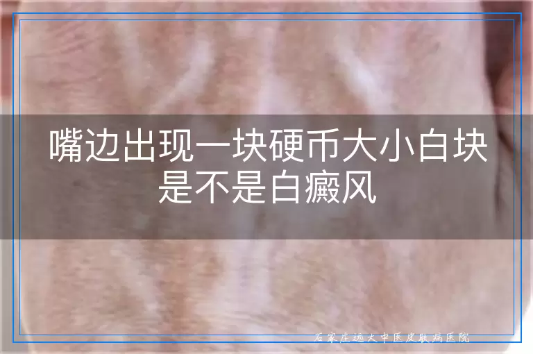 嘴边出现一块硬币大小白块是不是白癜风