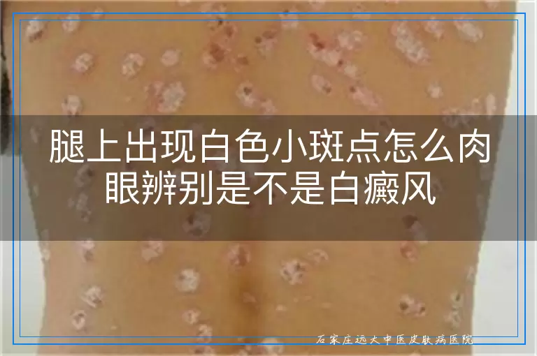 腿上出现白色小斑点怎么肉眼辨别是不是白癜风