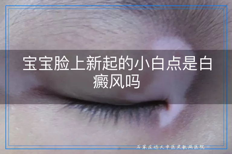 宝宝脸上新起的小白点是白癜风吗