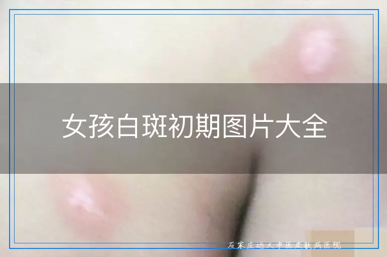 女孩白斑初期图片大全