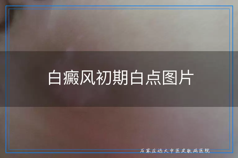 白癜风初期白点图片