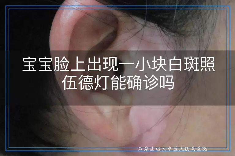 宝宝脸上出现一小块白斑照伍德灯能确诊吗
