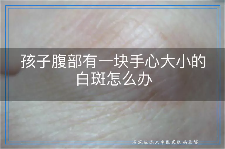 孩子腹部有一块手心大小的白斑怎么办