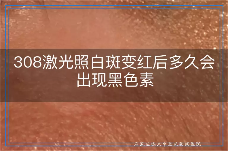 308激光照白斑变红后多久会出现黑色素