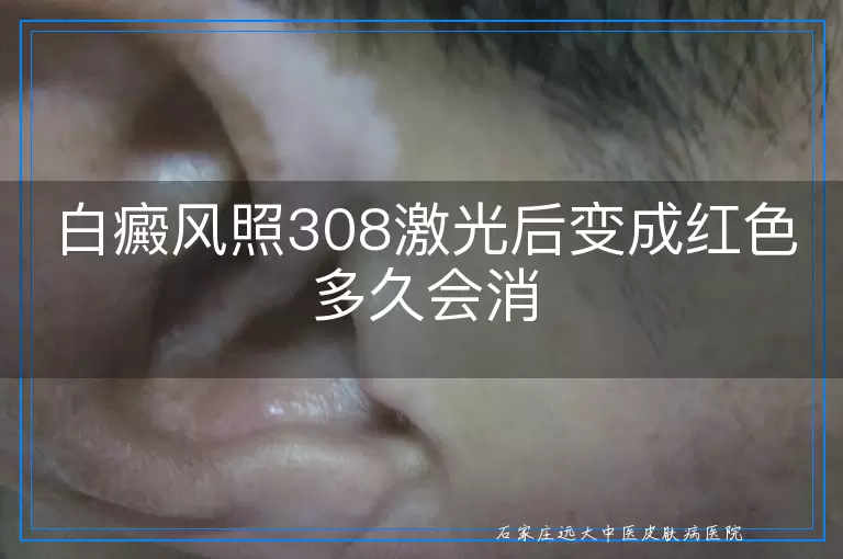 白癜风照308激光后变成红色多久会消