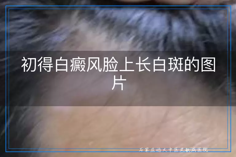 初得白癜风脸上长白斑的图片