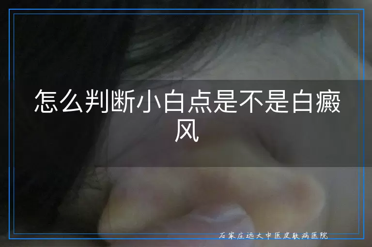 怎么判断小白点是不是白癜风