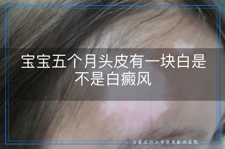 宝宝五个月头皮有一块白是不是白癜风