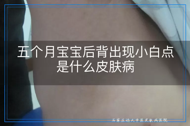 五个月宝宝后背出现小白点是什么皮肤病