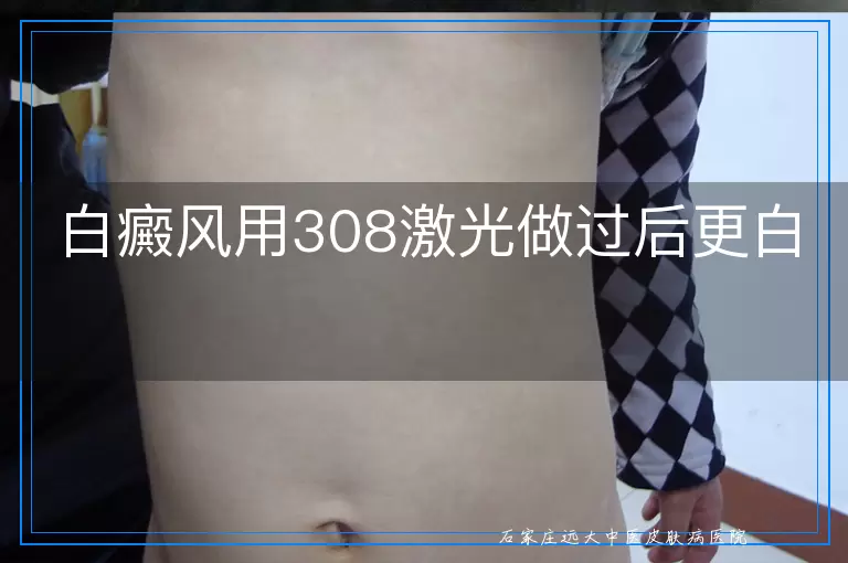白癜风用308激光做过后更白