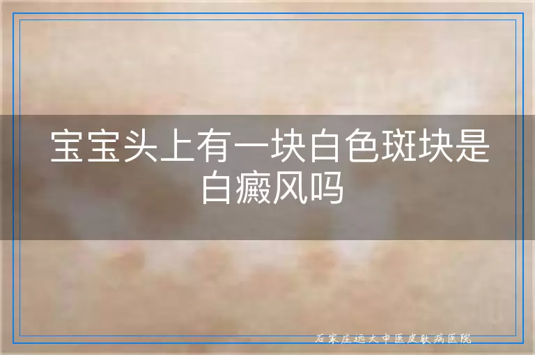 宝宝头上有一块白色斑块是白癜风吗