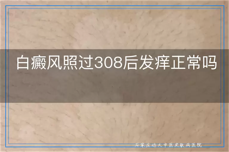 白癜风照过308后发痒正常吗