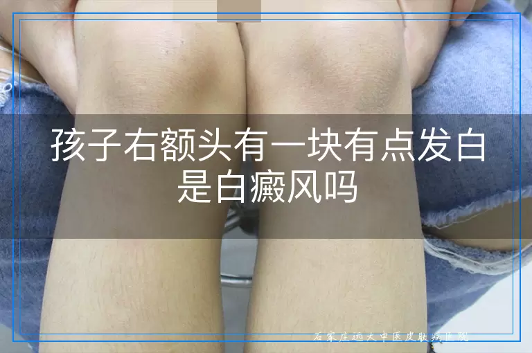 孩子右额头有一块有点发白是白癜风吗