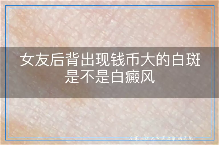 女友后背出现钱币大的白斑是不是白癜风