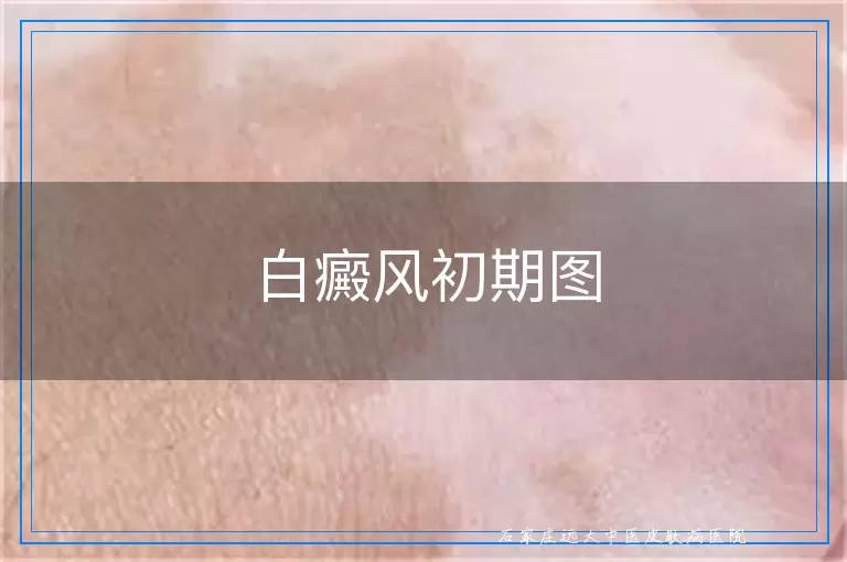 白癜风初期图