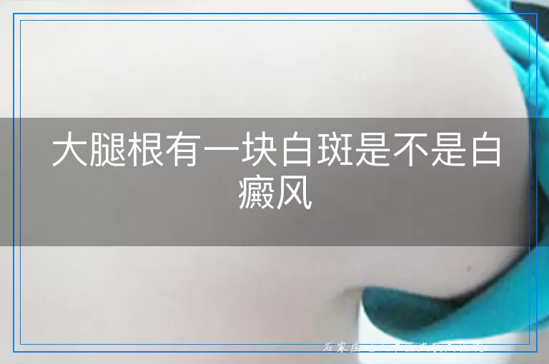 大腿根有一块白斑是不是白癜风