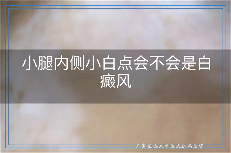 小腿内侧小白点会不会是白癜风