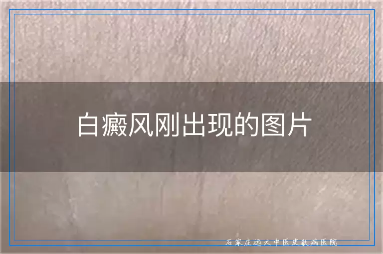 白癜风刚出现的图片
