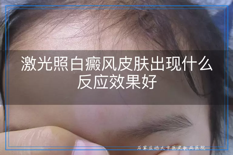 激光照白癜风皮肤出现什么反应效果好