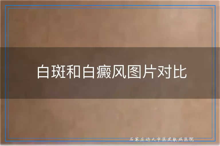 白斑和白癜风图片对比