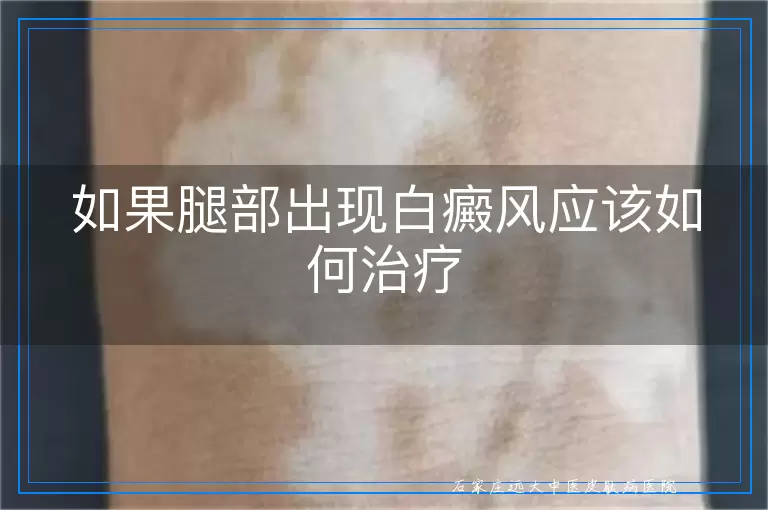 如果腿部出现白癜风应该如何治疗