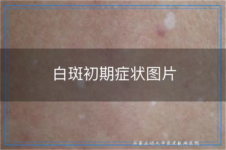 白斑初期症状图片