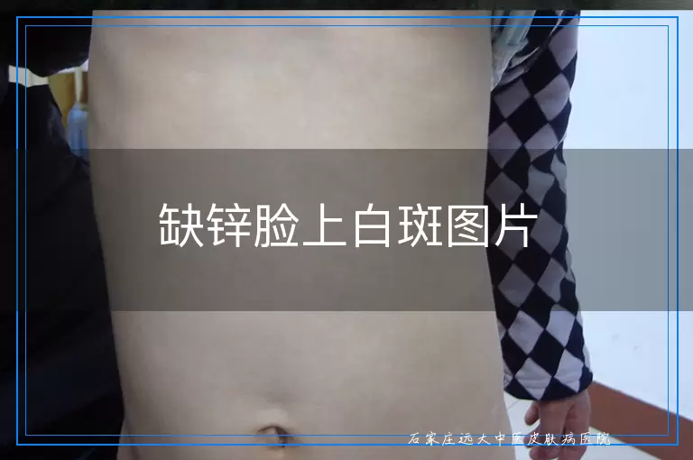 缺锌脸上白斑图片
