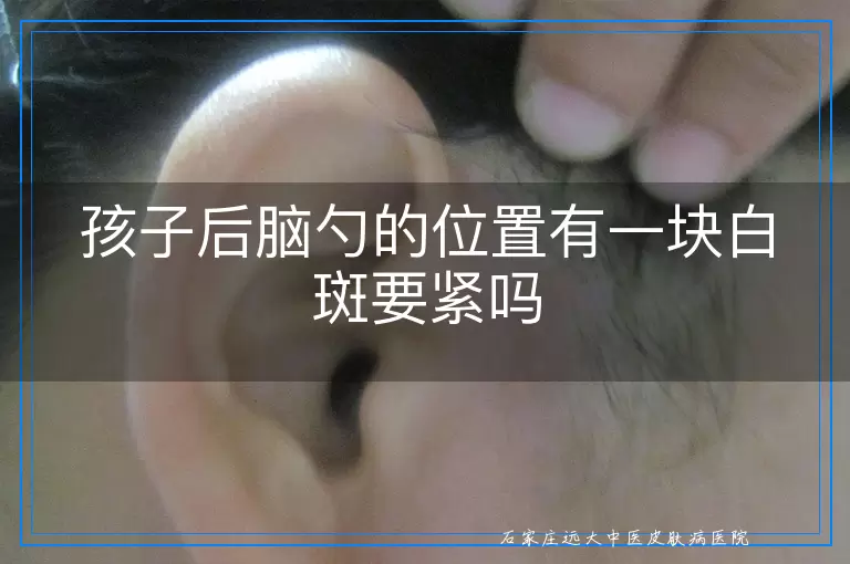 孩子后脑勺的位置有一块白斑要紧吗