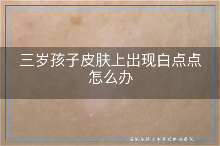 三岁孩子皮肤上出现白点点怎么办