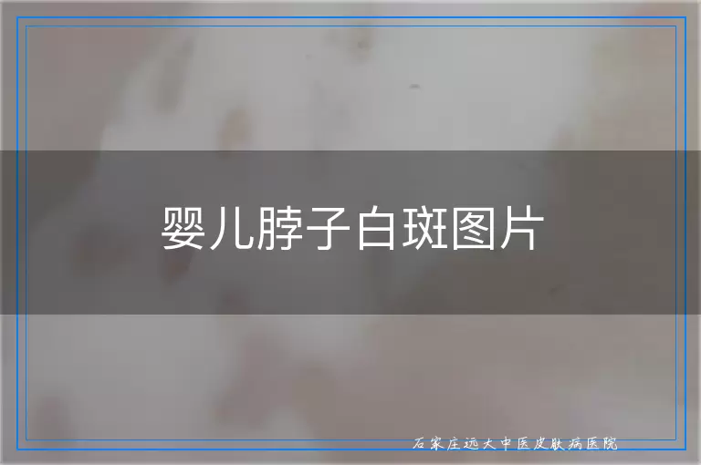 婴儿脖子白斑图片
