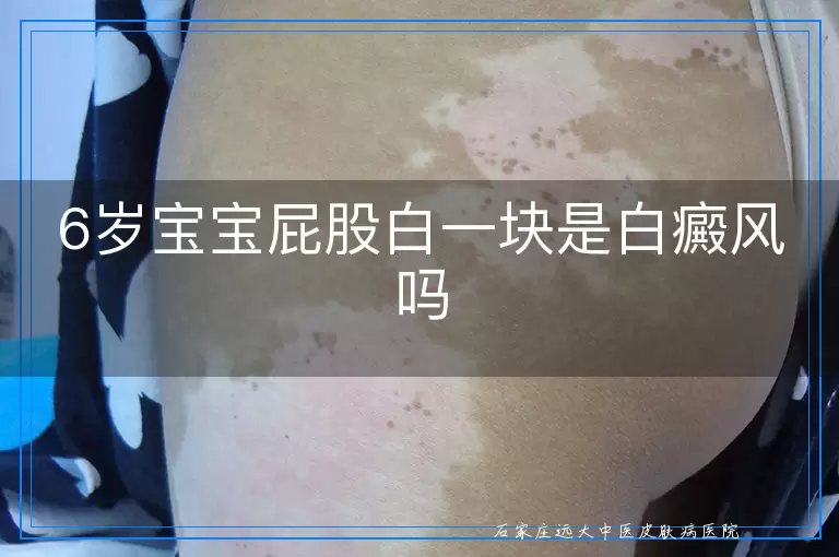 6岁宝宝屁股白一块是白癜风吗