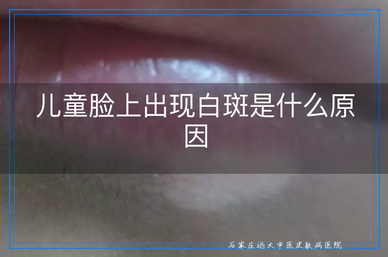 儿童脸上出现白斑是什么原因