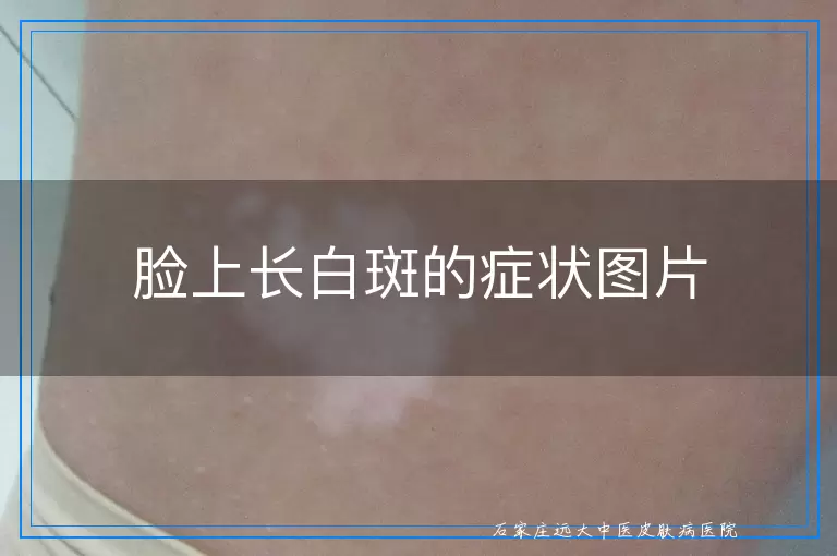 脸上长白斑的症状图片