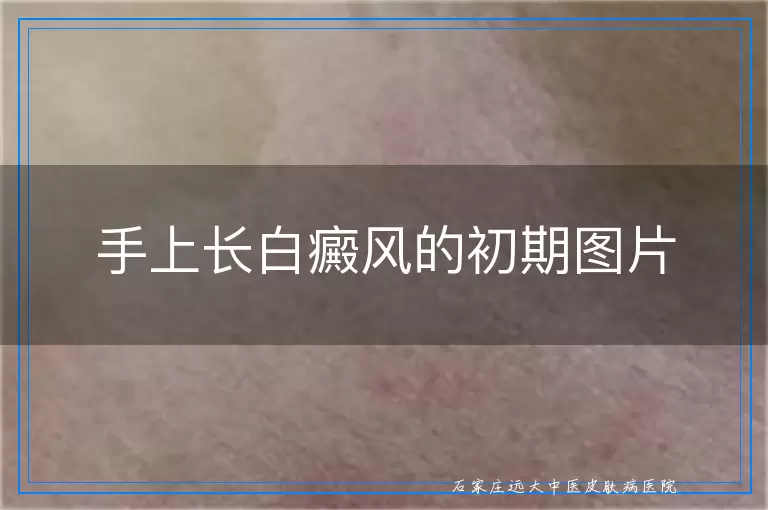 手上长白癜风的初期图片