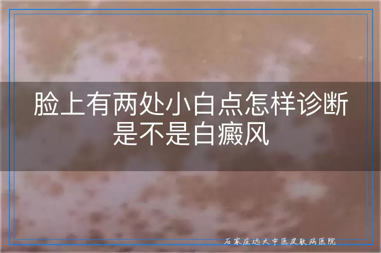 脸上有两处小白点怎样诊断是不是白癜风