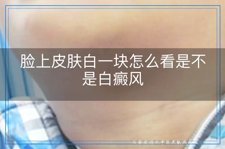 脸上皮肤白一块怎么看是不是白癜风