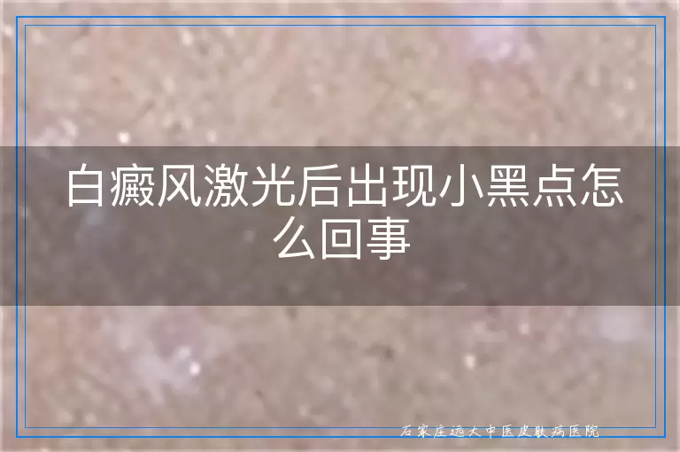 白癜风激光后出现小黑点怎么回事