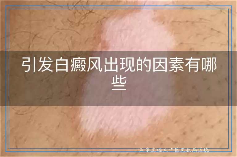 引发白癜风出现的因素有哪些