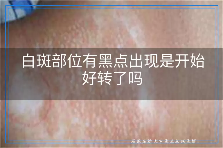 白斑部位有黑点出现是开始好转了吗