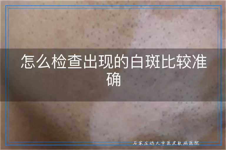 怎么检查出现的白斑比较准确