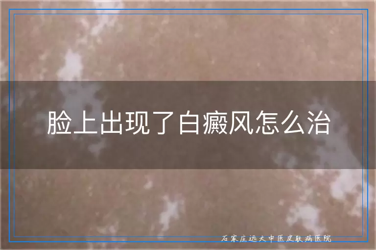 脸上出现了白癜风怎么治