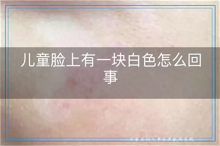 儿童脸上有一块白色怎么回事