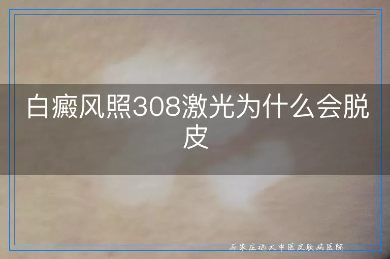 白癜风照308激光为什么会脱皮