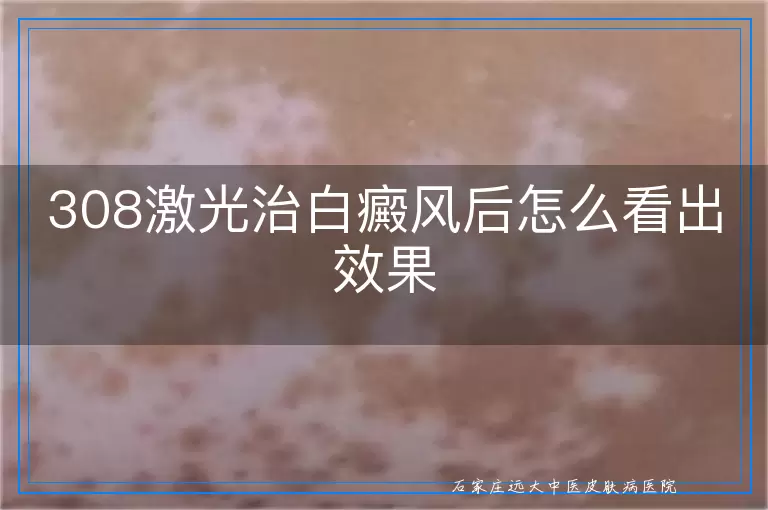 308激光治白癜风后怎么看出效果