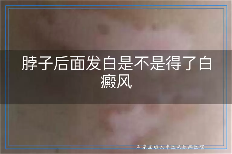 脖子后面发白是不是得了白癜风