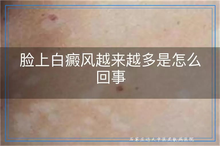 脸上白癜风越来越多是怎么回事