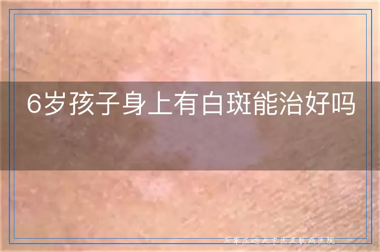 6岁孩子身上有白斑能治好吗