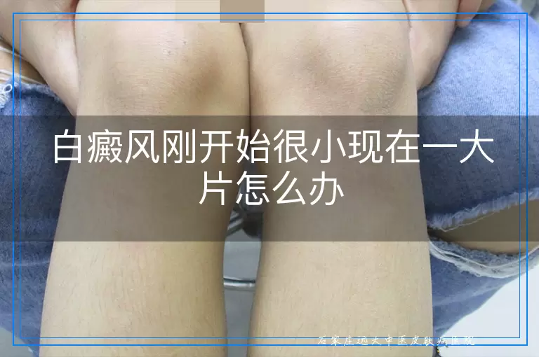 白癜风刚开始很小现在一大片怎么办