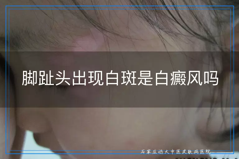脚趾头出现白斑是白癜风吗